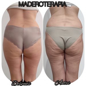 Antes y después de maderoterapia para reducir celulitis y reafirmar glúteos