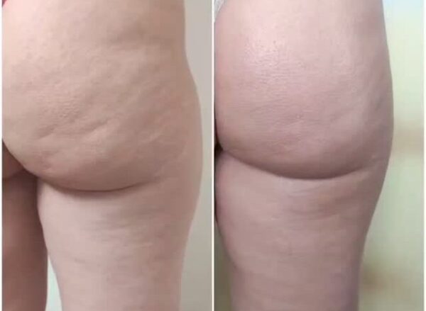 Antes y después de tratamiento anticelulítico